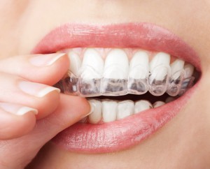 Teeth Aligners