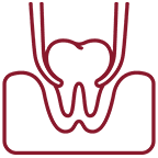 Wisdom Tooth Extraction