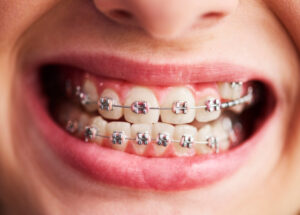 Dental Braces